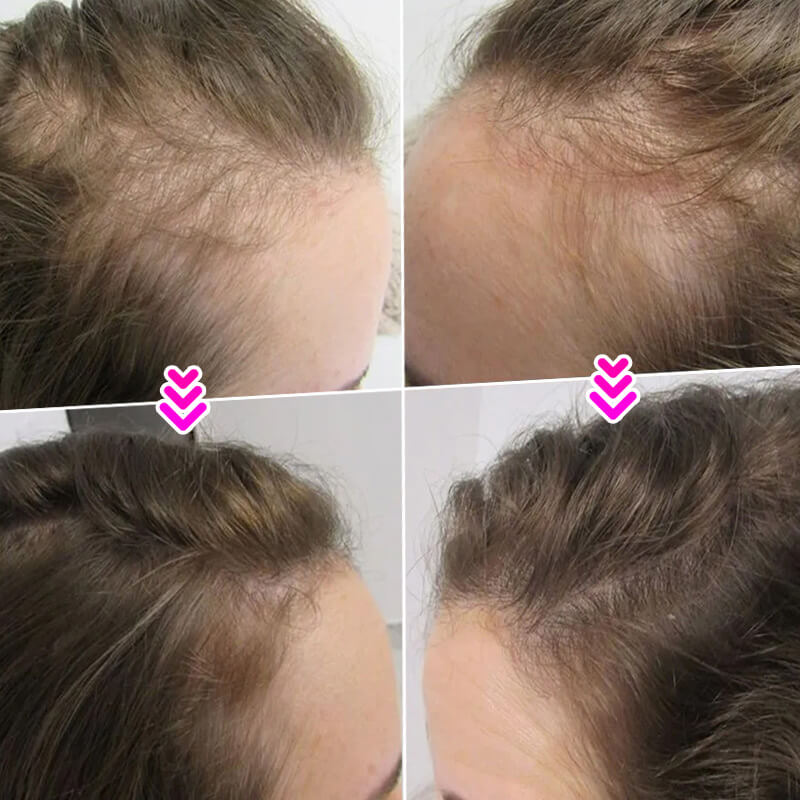 EELHOE HAIR™  Puder przeciw wypadaniu włosów i szybkie wypełnienie linii włosów