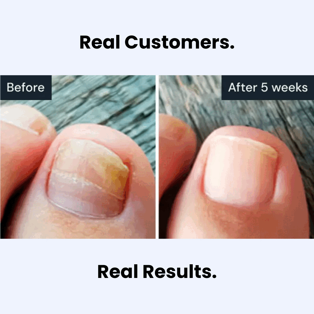 NailClear Pro+™ preparat na problemy z paznokciami z aplikatorem pędzelkowym